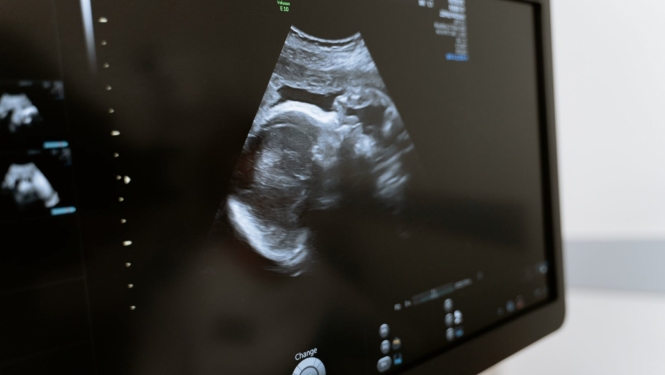 Ultrasonogrammas attēls