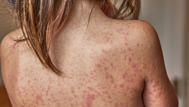 bērna mugura ar tipiskiem msalu izsitumiem